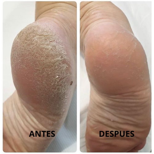 FootCare Max® - Eliminador de Callos en Casa
